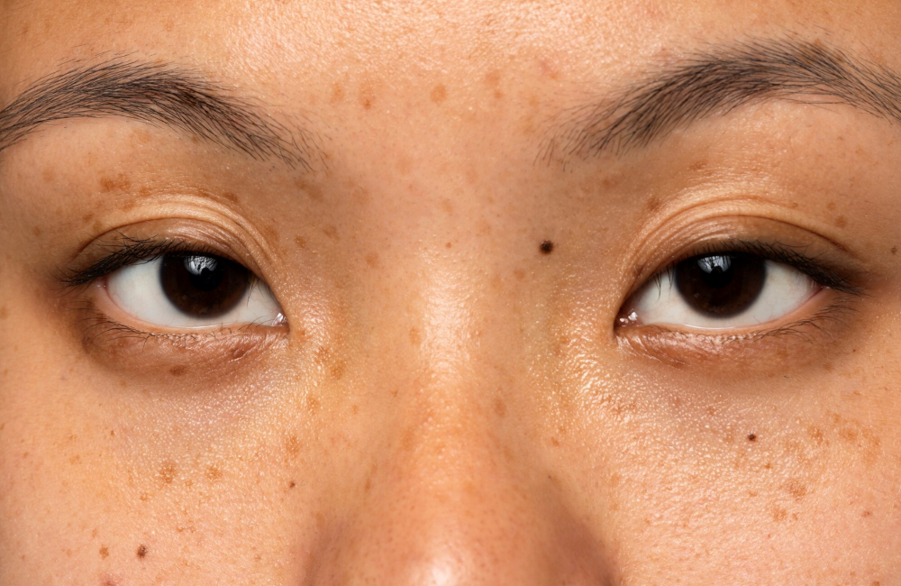 กล้ามเนื้อตาอ่อนแรง