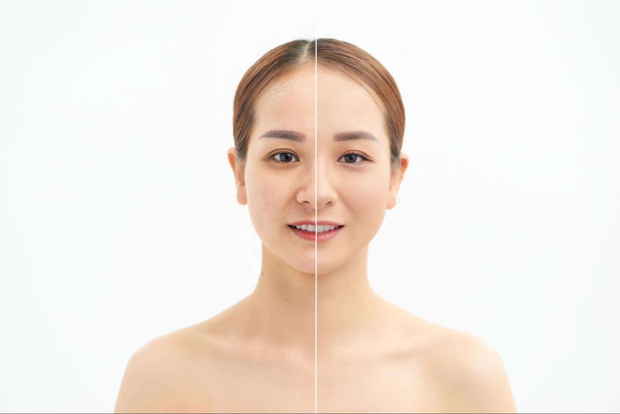 Ulthera SPT vs Ulthera Prime ต่างกันยังไง